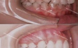 矫正拔牙后，牙齿的移动和最终排列会受影响吗？