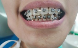 无锡整牙齿矫正效果如何？