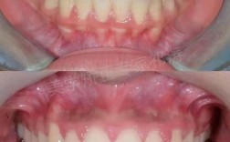 牙齿矫正后咬合不好，究竟是矫正方案问题还是自身因素影响？