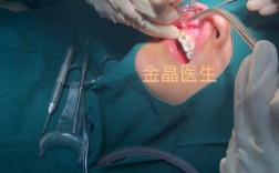 正畸骨皮质切开术视频，术式要点如何直观呈现？