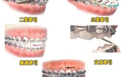 正畸牵引调整中缝