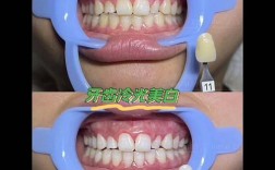 正畸矫正完冷光美白