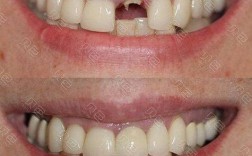 种牙整牙能同时进行吗？效果与风险如何？