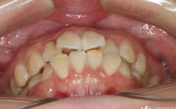 矫正牙齿拔6号牙