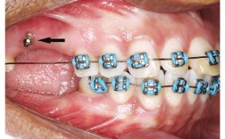 正畸支抗钉磨牙前移的操作步骤是怎样的？