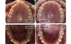 厦门牙齿矫正对比