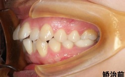 牙齿矫正为何要磨牙？磨小牙齿有风险吗？