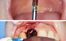 正畸种植钉误吞