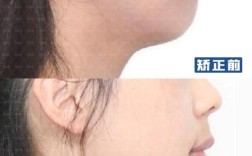 正畸什么脸型改变大？龅牙还是地包天效果显著？