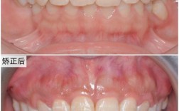 矫正牙齿真能改善牙周炎吗？