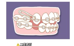 正畸颌间牵引分几类