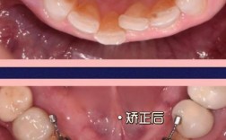 成年人牙齿舌侧矫正，效果如何？适合哪些人群？