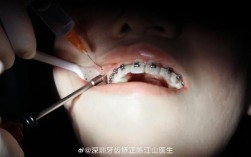 深圳牙齿正畸经历如何？效果、过程、费用大揭秘？