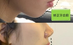 骨性龅牙正畸能治好吗？矫正效果如何？