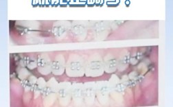 正畸去代偿到底是什么意思？