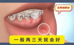 矫正牙齿钢丝刺到嘴，是什么原因？该如何处理？