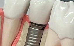 精密附着体种牙的优势体现在哪些方面？