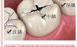 有龋齿的人能种牙吗？是否需先治疗龋齿再进行种植牙？