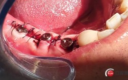 即拔即种牙实例，当天种牙真的可行吗？效果与风险如何评估？