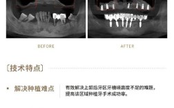 种牙上颌窦提拉是什么？技术原理、效果及安全风险如何？