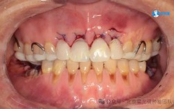 正畸治疗中创伤牙合的成因有哪些？危害是什么？如何应对？