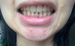 正畸下牙只拔一颗