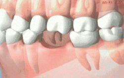 种牙过程动态图