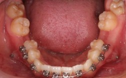 正畸推簧为何会把门牙顶歪？原因分析与应对方法