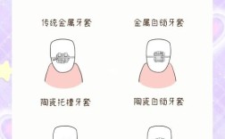 自锁正畸需要分牙吗