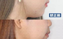 正畸期间后牙齿开合