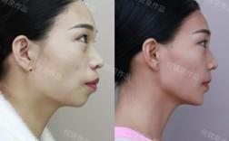 先颏成型后正畸