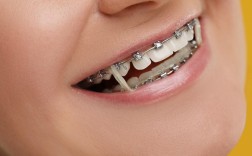 正畸治疗中牙齿带环的正确位置如何找准？