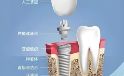 植牙成功的标准究竟包含哪些关键衡量指标？