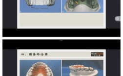 正畸金属托槽临床研究