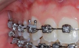 牙齿正畸去哪家好？靠谱机构怎么选？