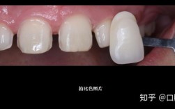 正畸后黑三角，牙贴面修复效果如何？