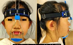 口外正畸牵引器图片能展示哪些关键结构？