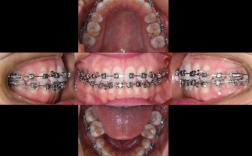 开颌 正畸 复发