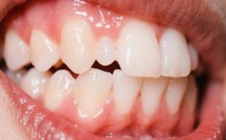 种牙后还会掉吗？种植牙脱落风险与稳定性疑问解析