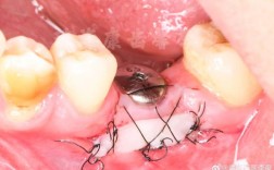 种牙移植牙龈