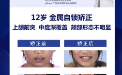 上颚前突手术方法有哪些？哪种更适合自己？