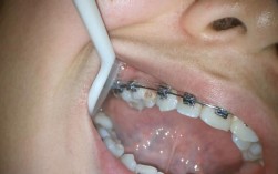 牙齿正畸会让龋齿风险升高吗？