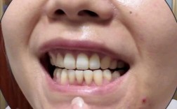 正畸后种牙周期多长？有哪些关键影响因素？