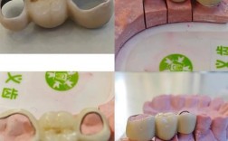 深圳镶牙补牙种牙服务该怎么选？哪种方式更适合自己呢？