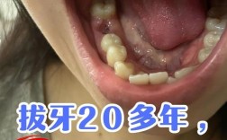 牙周病拔牙后到底能不能种牙？这些因素决定成败！