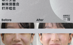 拔八颗牙矫正牙齿