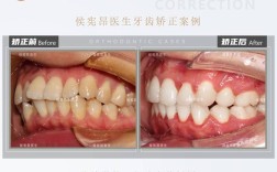 牙齿矫正会导致舌头变大吗？