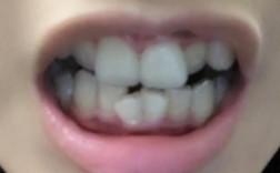 做过隐形矫正牙齿吗？效果、舒适度怎么样？过来人聊聊！