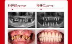 种植牙方式哪种好？如何根据口腔状况选适合的？