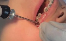 正畸上前牙种植钉的最佳位置如何确定？